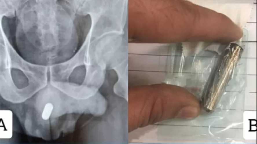 Homem passa por cirurgia após introduzir pilha no pênis