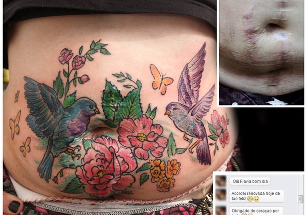 Essas cicatrizes foram causadas por uma tentativa de homicídio. As marcas são das facadas e da cirurgia de emergência que a mulher sofreu. (Foto: Reprodução Facebook) — Foto: Glamour