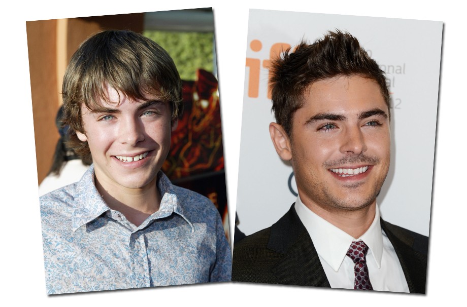 Zac Efron juntou os dentes da frente e ficou com o rosto menos infantil, não acham?
