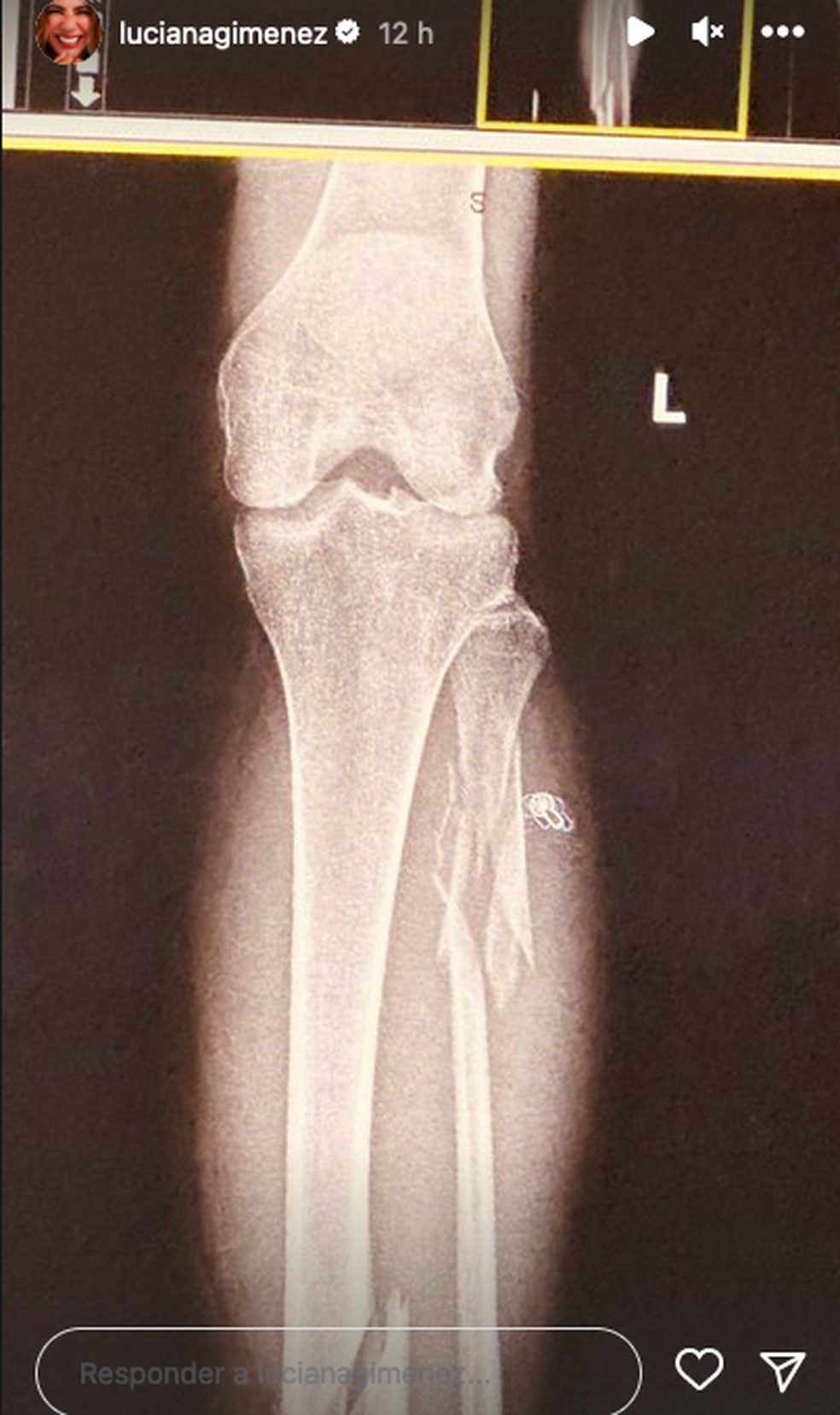 Apresentadora posta raio x da perna — Foto: Reprodução/Instagram