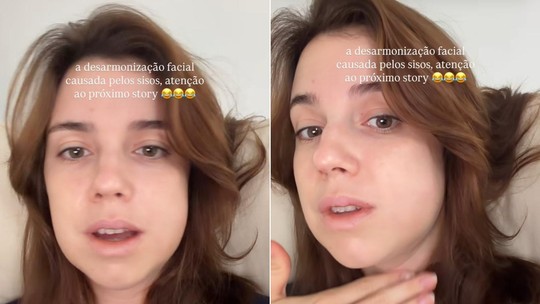 Alice Wegmann se diverte com inchaço no rosto após extração do siso: 'Desarmonização facial'