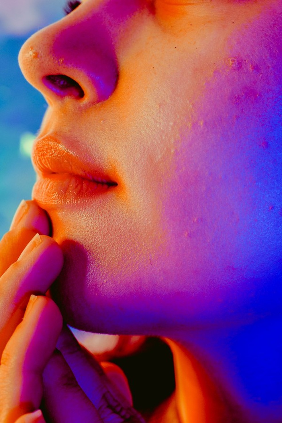 Acne adulta: entenda as causas e tratamentos (Foto: Getty Images) — Foto: Glamour