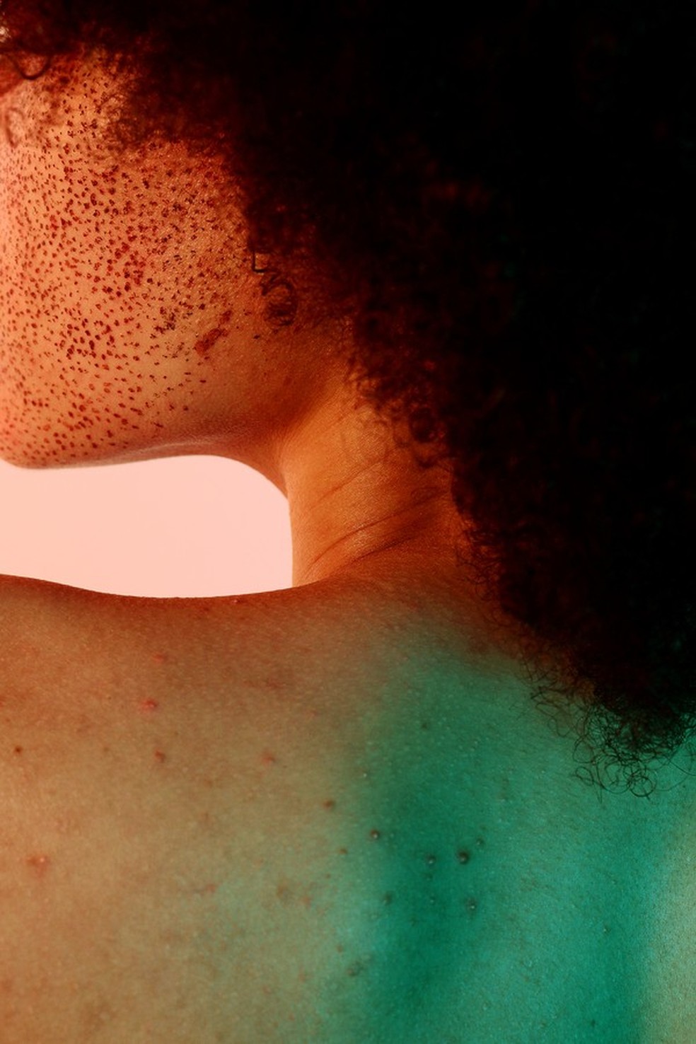 Acne fúngica: entenda as causas e tratamentos (Foto: Getty Images) — Foto: Glamour