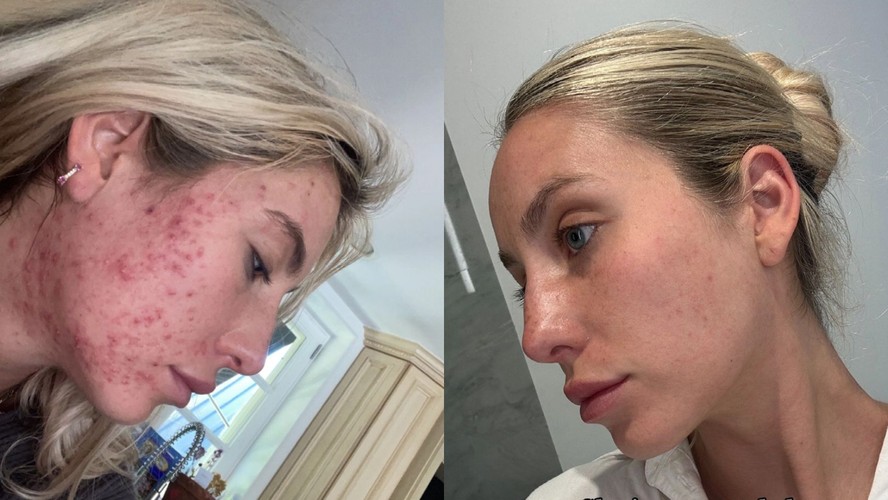 Influenciadora exibe antes e depois impressionante do tratamento contra a acne