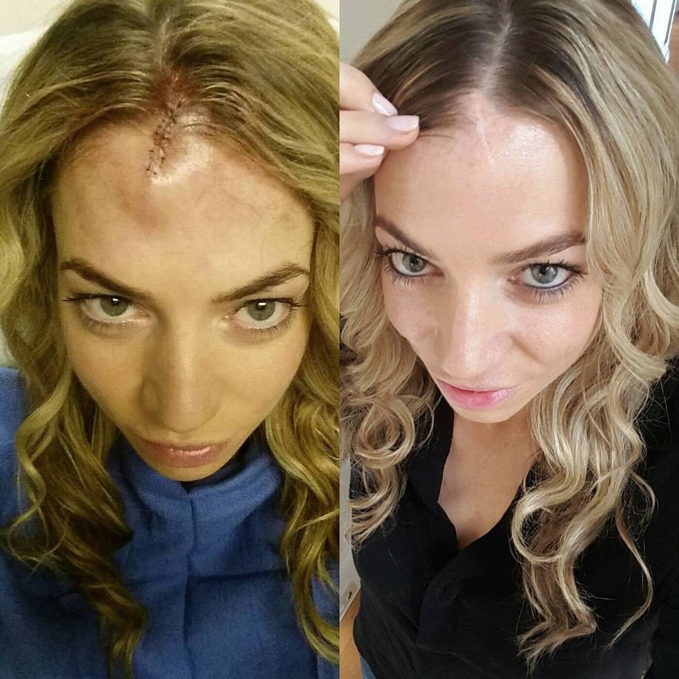 Megan Sullivan mostra antes e depois da remoção do câncer na pele (Foto: Reprodução/ Instagram) — Foto: Glamour