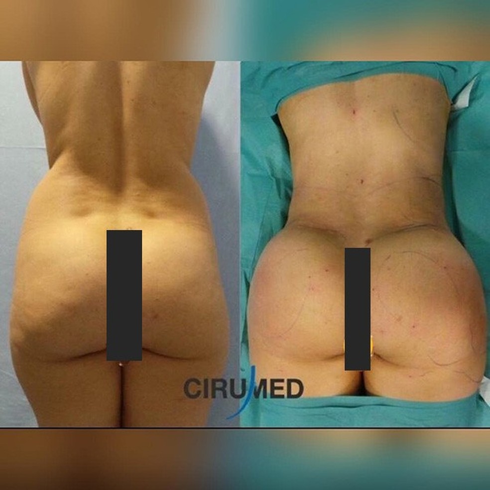 Brazilian Butt Lift (Foto: Reprodução/Instagram) — Foto: Glamour