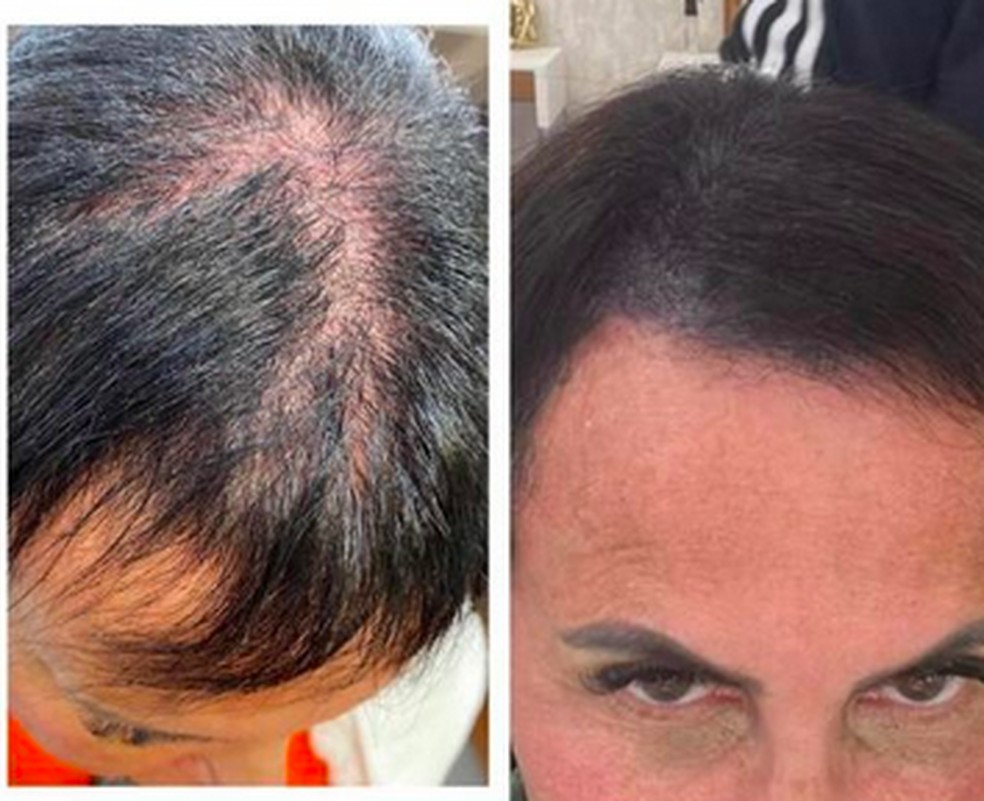 Gretchen mostra antes e depois — Foto: Reprodução/Instagram