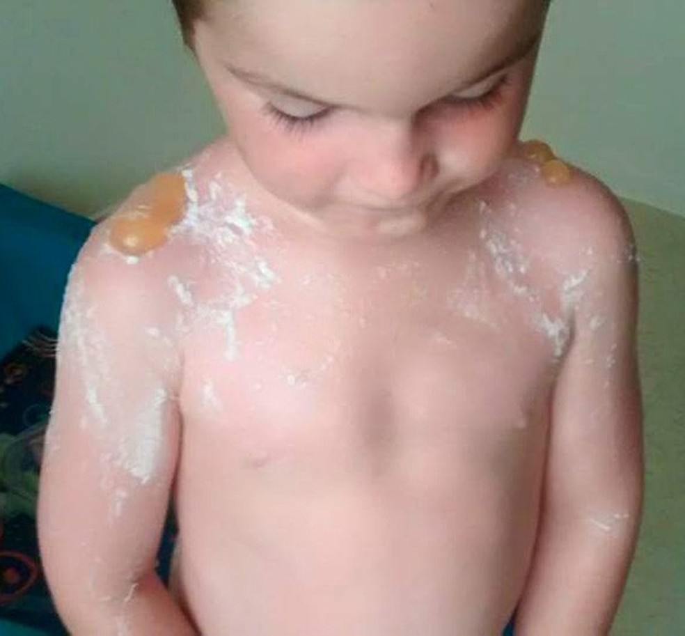 Tray Wells, de 5 anos, exibe queimaduras para mãe (Foto: Reprodução) — Foto: Glamour