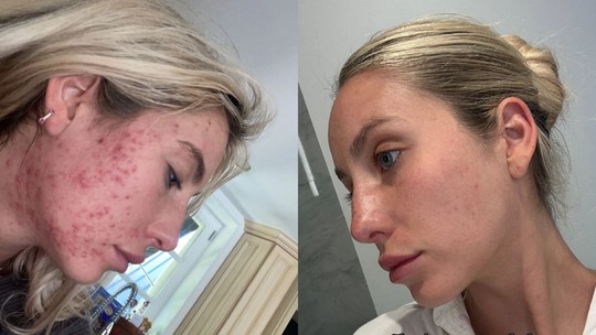 Influenciadora exibe jornada contra a acne e fotos impressionam: 'tudo pode melhorar'