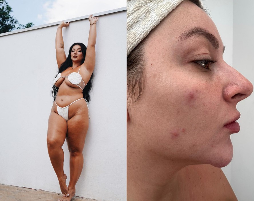 Letticia Munniz relata quadro de acne após inserção de DIU