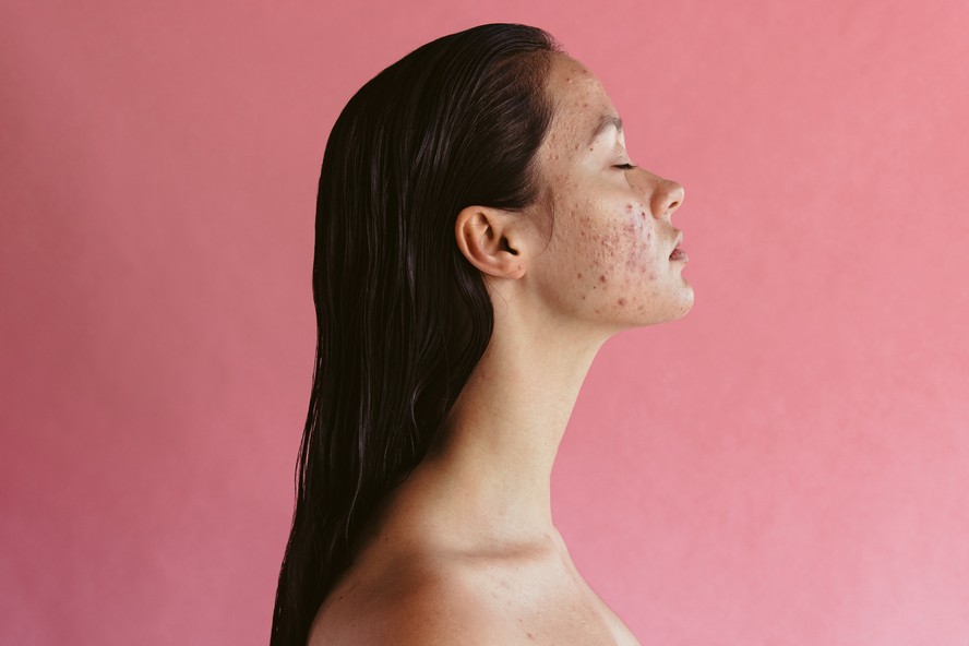 Veja como é a acne da síndrome dos ovários policísticos e como tratá-la