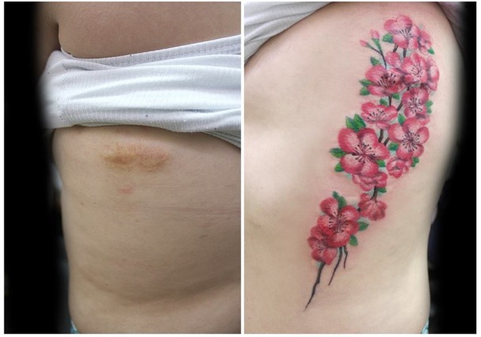 Essa cicatriz foi causada por um tiro disparado pelo ex-namorado da vítima. (Foto: Reprodução Facebook) — Foto: Glamour
