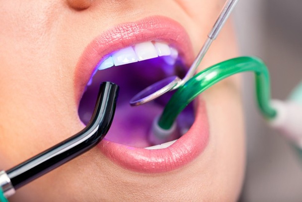 Clareamento dental: esclareça suas dúvidas (Foto: ThinkStock) — Foto: Glamour