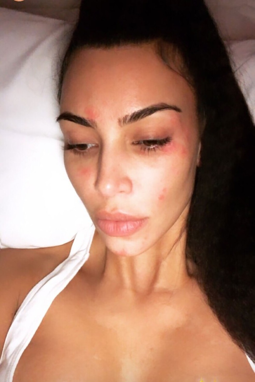Kim Kardashian sofre de psoríase (Foto: Instagram/Reprodução) — Foto: Glamour