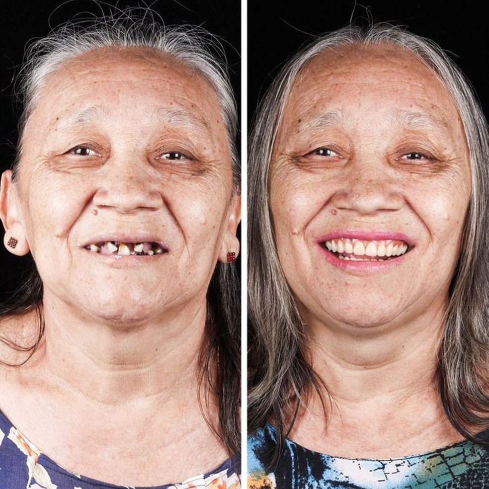 Antes e depois de uma paciente (Foto: Reprodução/Instagram) — Foto: Glamour