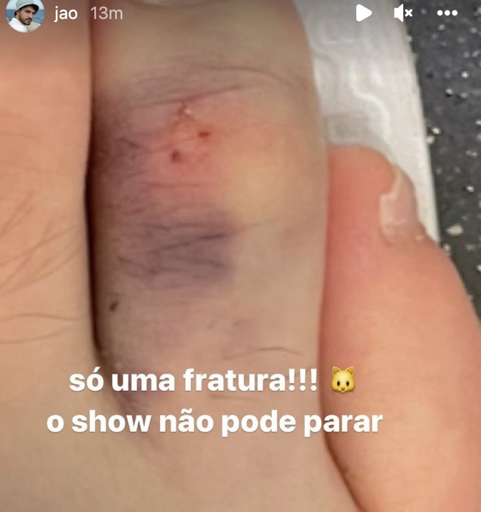 Fratura no dedo, cantor Jão — Foto: Reprodução/Instagram