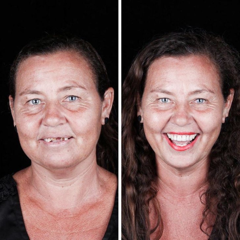 Antes e depois de uma paciente (Foto: Reprodução/Instagram) — Foto: Glamour