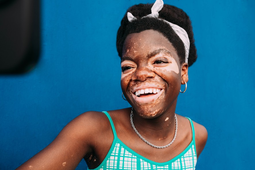 Vitiligo: o que é, causas, tratamento e como combater o estigma da condição de pele