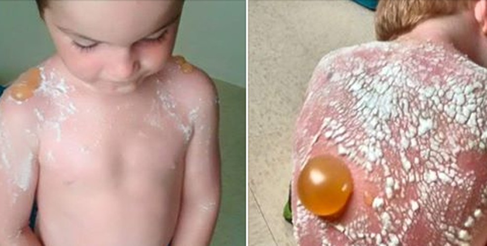 Crianças sofrem graves queimaduras de sol em creche (Foto: Reprodução) — Foto: Glamour