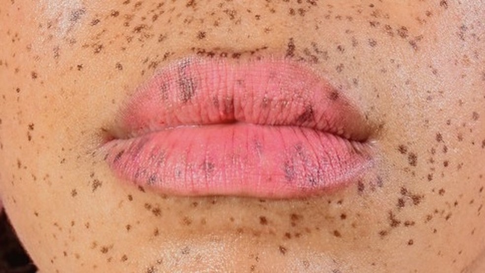 Lábios ressecados? Nunca mais com o guia dos lip balms — Foto: Getty Images
