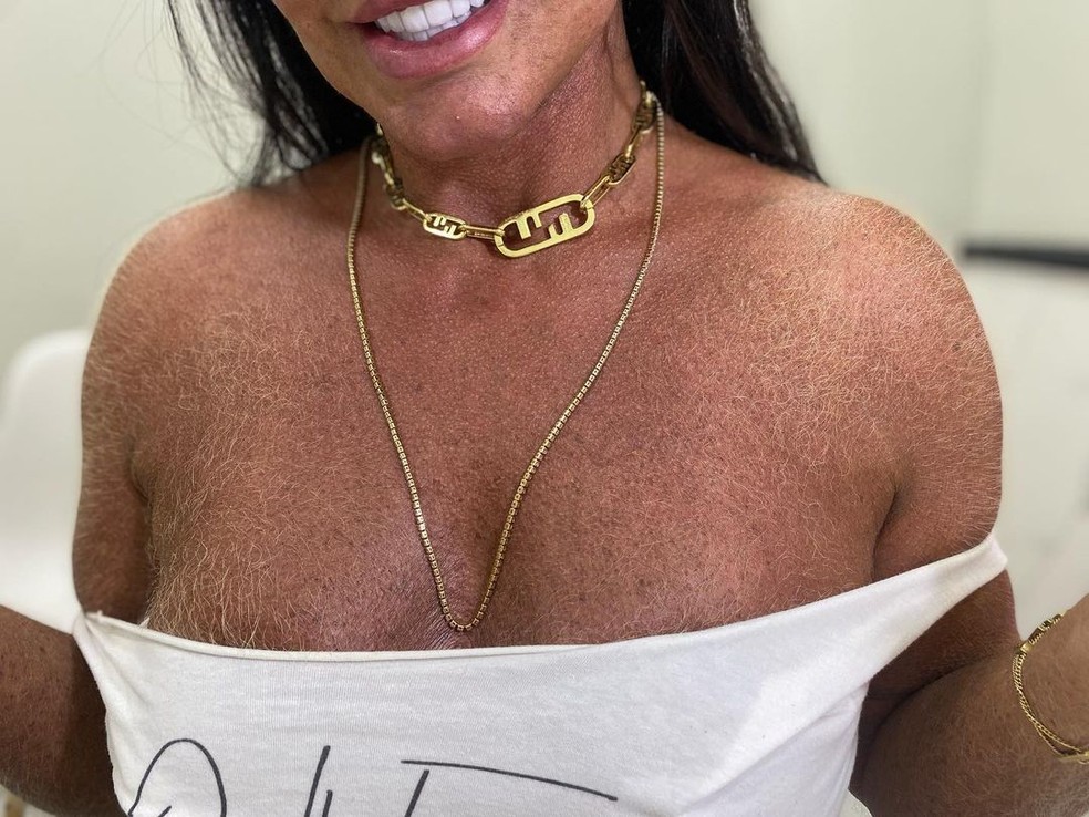 Gretchen notou o nascimento de pelos no colo e nos ombros após tratamento com testosterona — Foto: Reprodução/Instagram 