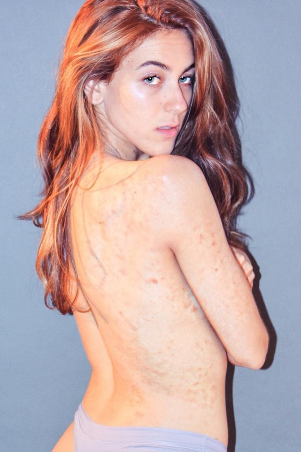 Psoríase (Foto: Reprodução Instagram @cienarae) — Foto: Glamour