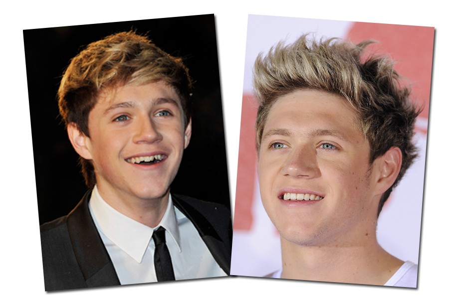 Quando entrou no X Factor UK, Niall Horan tinha os dentes bem tortos. Para corrigir, usou aparelho e tchanam!