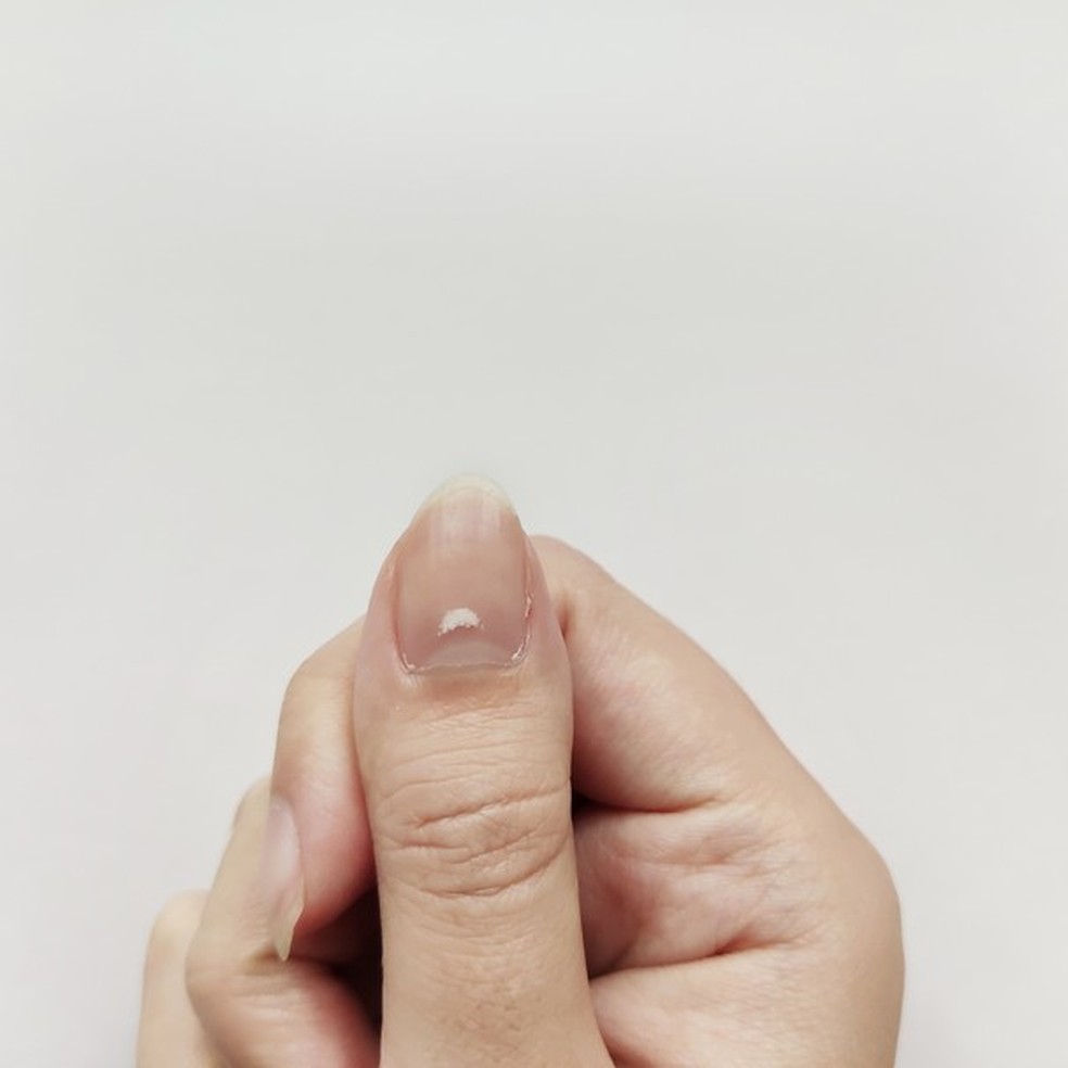 Ondulações e 'estrias' de unhas: saiba como tratar (Foto: Getty Images) — Foto: Glamour