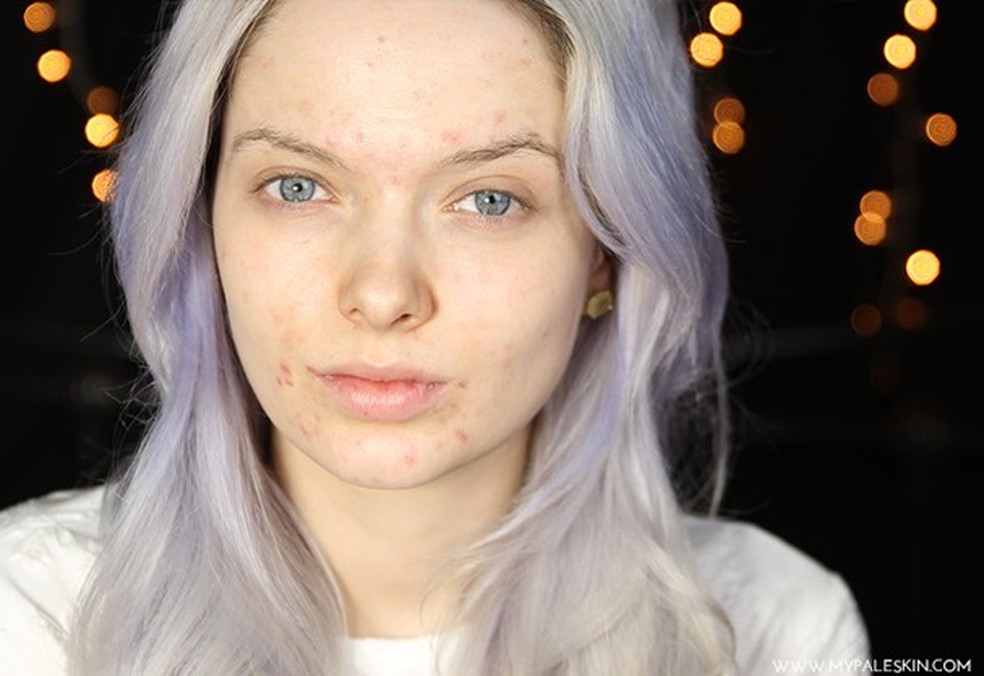 Em Ford, blogueira de beleza, disfarça toda a acne com maquiagem