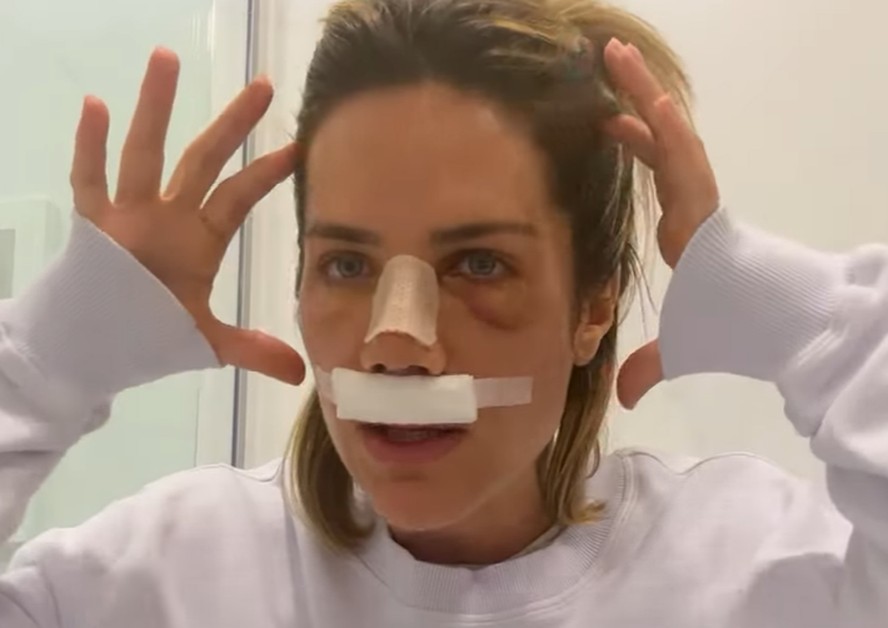 Vídeo: Giovanna Ewbank abre o jogo sobre cirurgia no nariz