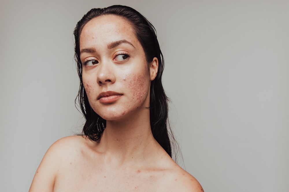 Tipos de acne conheça os 4 graus e saiba como cuidar