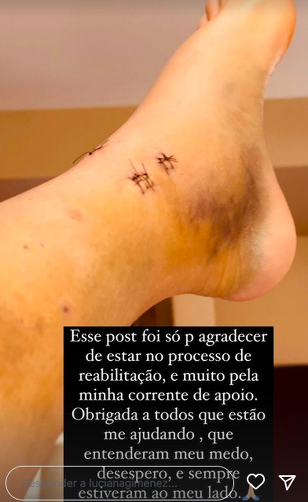 Luciana mostra pé fraturado — Foto: Reprodução/Instagram