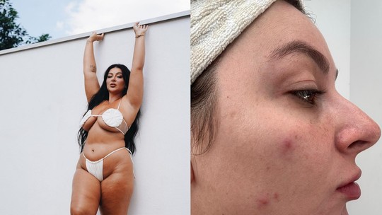 Letticia Munniz fala sobre luta contra acne após inserção de DIU: ‘pesa de dor, de tanta espinha’ 