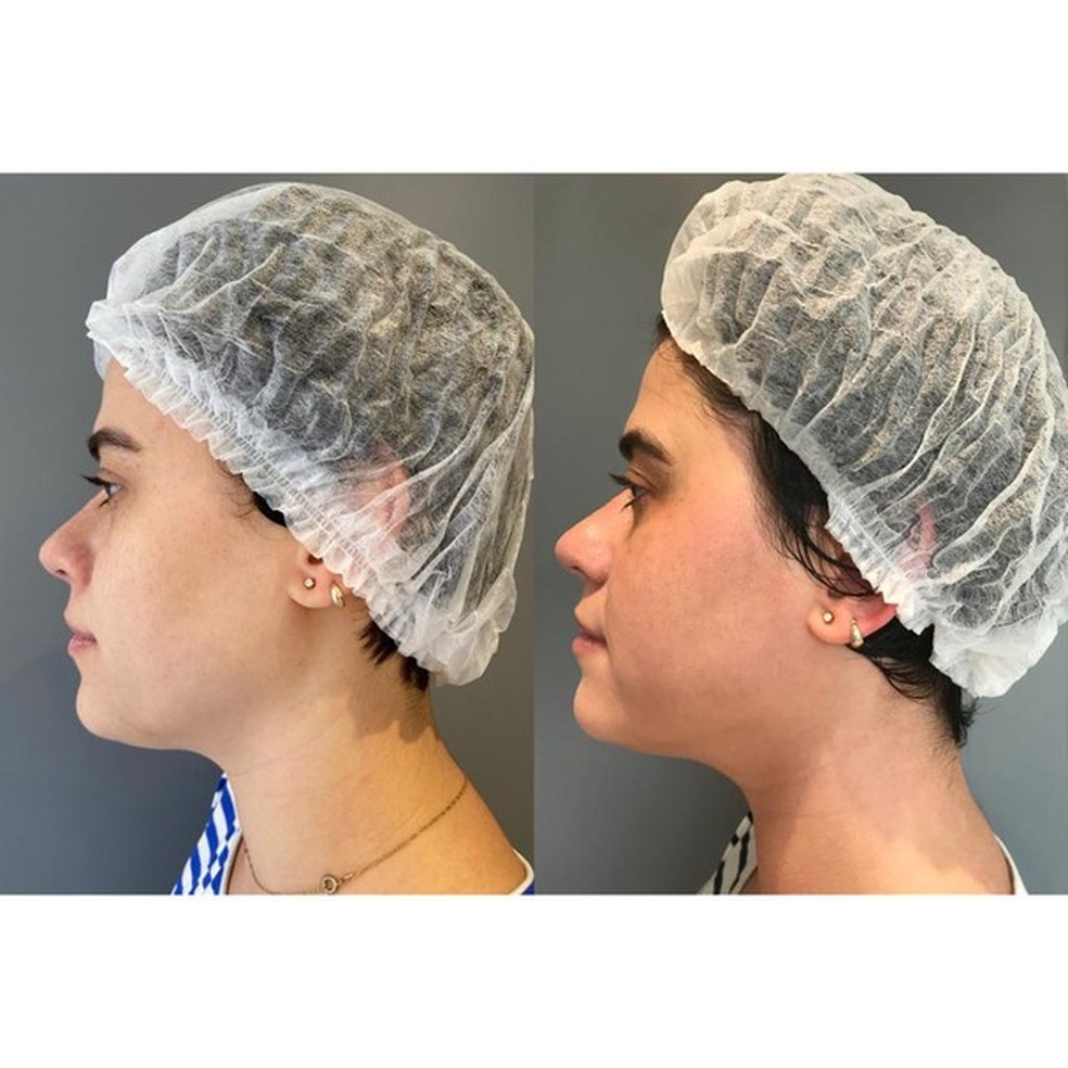 Do lado esquerdo, a foto de antes do tratamento; à direita, a foto depois do tratamento (Foto: Divulgação) — Foto: Glamour